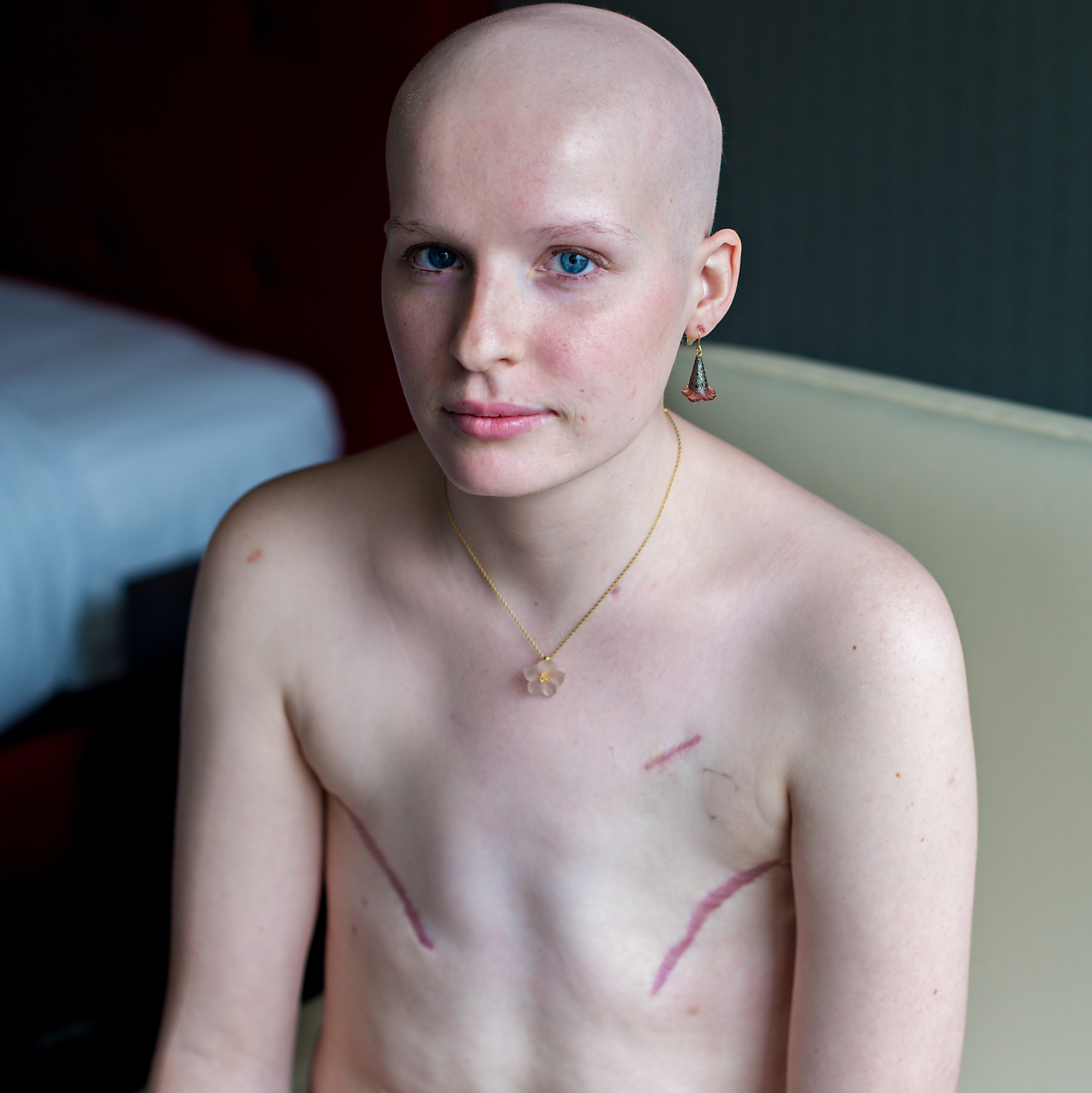 Фоторепортаж операции: маммопластика после рака молочной железы