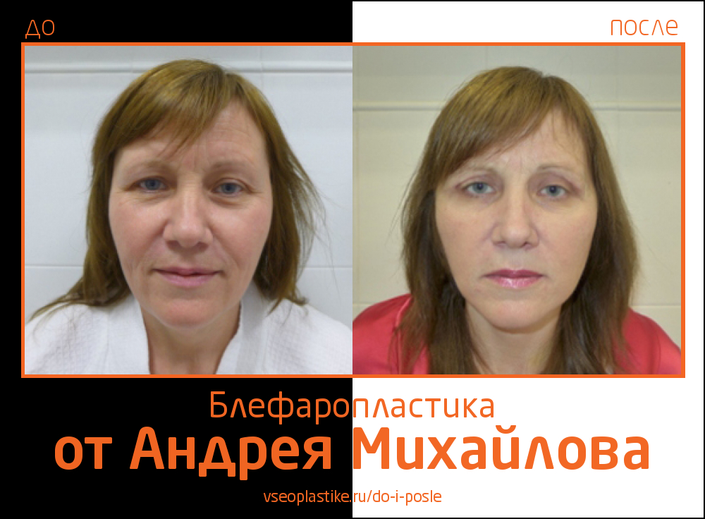 Николай анатольевич до и после пластики