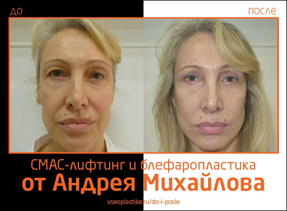 Николай анатольевич до и после пластики