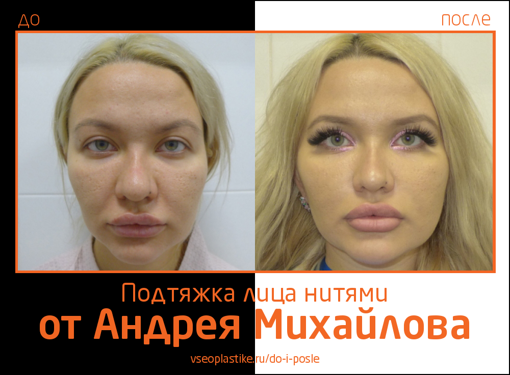 Николай анатольевич до и после пластики