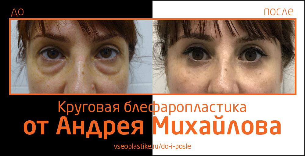 Николай анатольевич до и после пластики