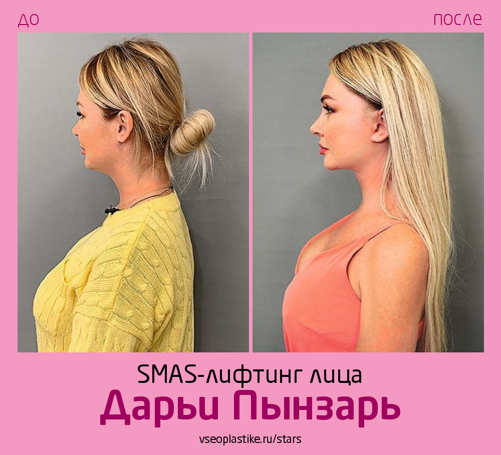 Дарья Пынзарь до и после SMAS-лифтинга