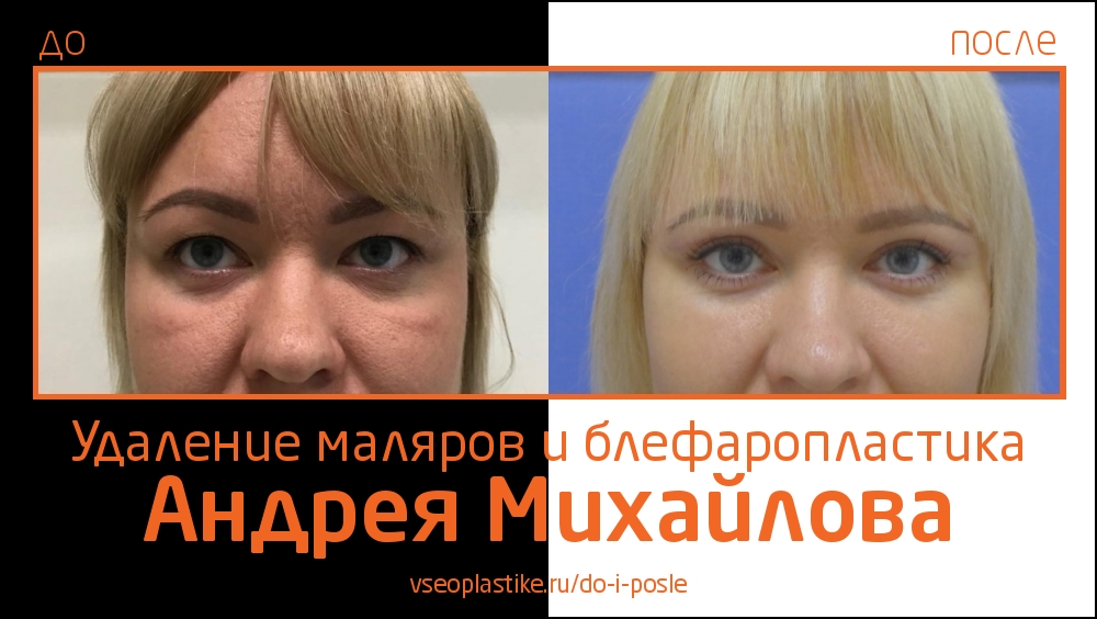 Николай анатольевич до и после пластики
