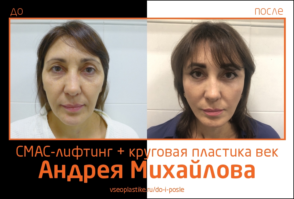 Николай анатольевич до и после пластики