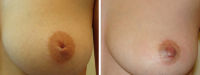 Втянутые соски. До и после операции. Вадим Баков