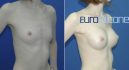 Сергей Блохин. Увеличение груди имплантами Eurosilicone
