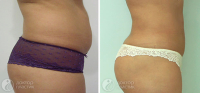 Пациентка до и после липосакции