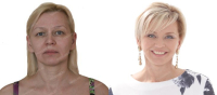 До и после омоложения лица