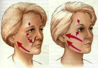 Эндоскопическая подтяжка лица