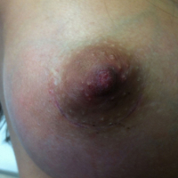 Состояние рубца через 4 недели после операции в клинике DoctorPlastic. Хирург Баков В.С.