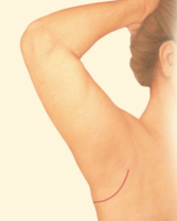 Подтяжка рук с коротким рубцом