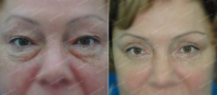 До и после блефаролифтинга