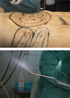 Разметка границ моделируемых зон. Трубочка-канюля