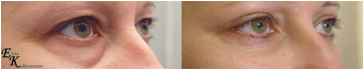 Блефаропластика верхних и нижних век в сочетании с кантопексией. Клиника Doctor Plastic, хирург Кахраманов.