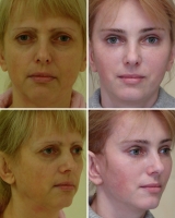 Результат через 4 месяца после операции