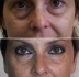 До и после процедуры Face Reshaping у Марко Мерлина
