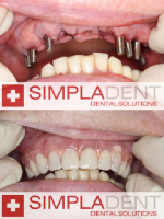 Базальная имплантация в SIMPLADENT