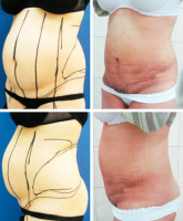 Сарвар Бакирханов. Абдоминопластика