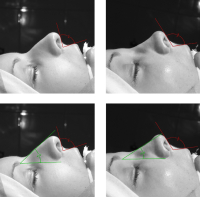 Институт красоты СПИК. Валерий Стайсупов. Ринопластика