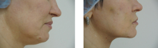 До пациентке проводилась классическая подтяжка нижней трети лица и подчелюстной зоны. Фото После процедуры FACE TITE сделано через 15 дней.