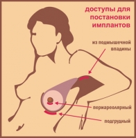 Способы установки имплантов