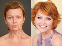 Лариса Плеско до и после пластики