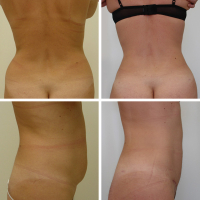 Мини-абдоминопластика. Пластический хирург Татьяна Иванченкова