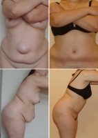 Светлана Пшонкина. Абдоминопластика с удалением грыж