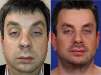 Виктор Буковинский до и после пластики