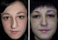 povtornaya_rinoplastika