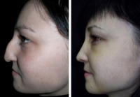 povtornaya_rinoplastika