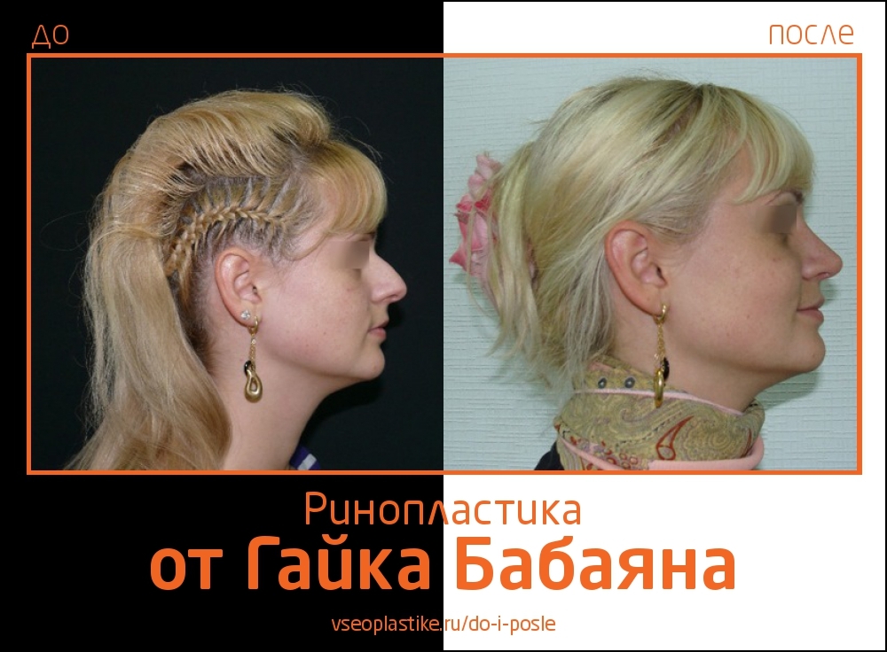 Изменение внешности Натальи Подольской после пластических операций