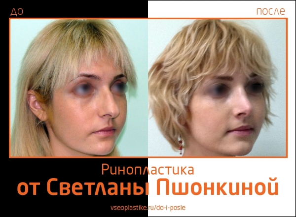 Все ответы по ринопластике Все ответы по ринопластике