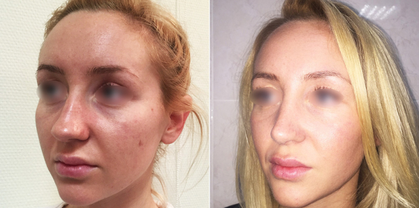 Фото до и после ринопластики у Светланы Пшонкиной