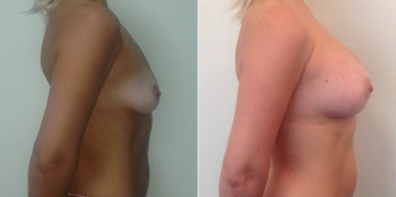 До и после увеличения груди у Светланы Пшонкиной