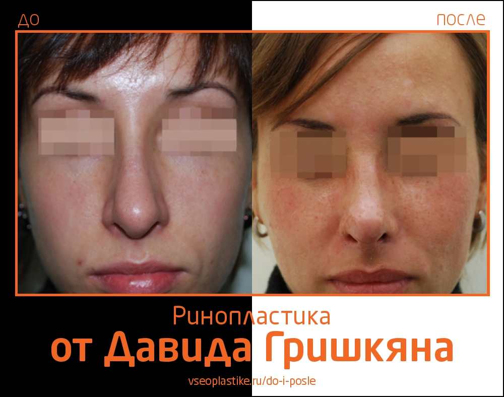 Пациентка Давида Гришкяна до и после ринопластики
