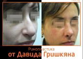 Фото до и после ринопластики от Давида Гришкяна