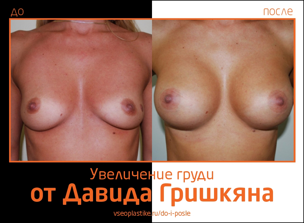 Увеличение груди от Давида Гришкяна
