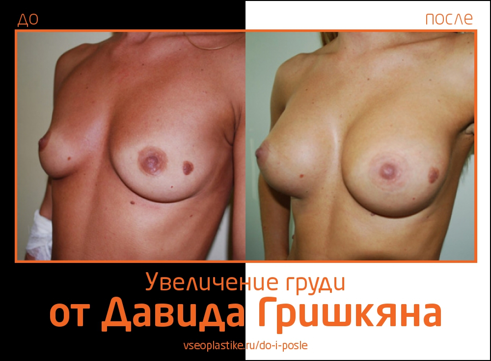 Увеличение груди от Давида Гришкяна