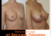 Увеличение груди до и после у Арслана Пенаева