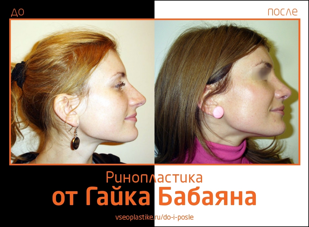 Увеличение груди гайк бабаян Увеличение груди гайк бабаян