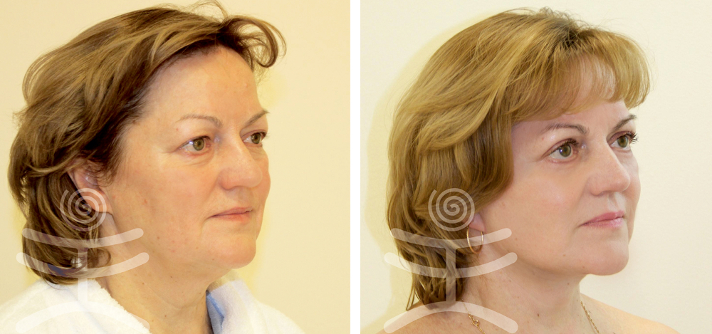 Лифтинг Мендельсона. До и после