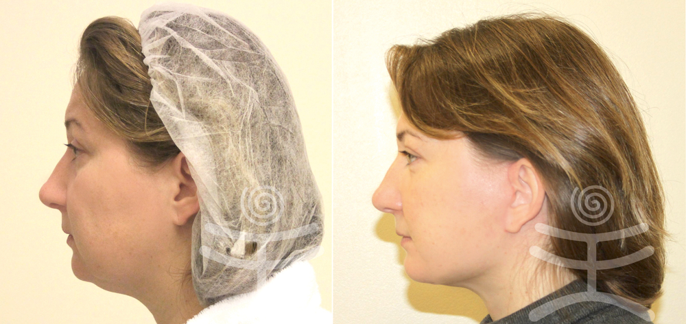 Лифтинг Мендельсона. До и после