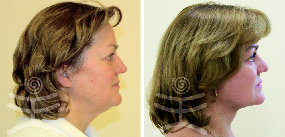 Лифтинг Мендельсона. До и после