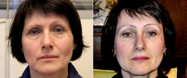 Фото пациентки до и после фейслифтинга в ОН КЛИНИК