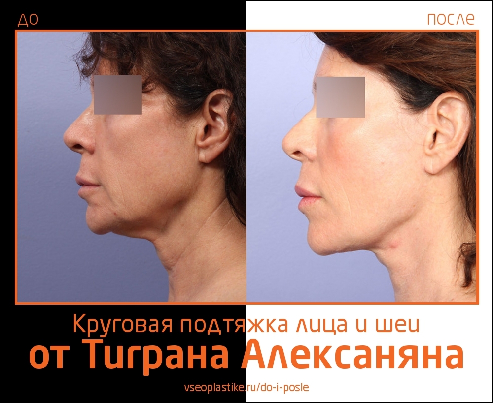 Как сделать круговую подтяжку 720