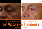 До и после круговой блефаропластики у Арслана Пенаева
