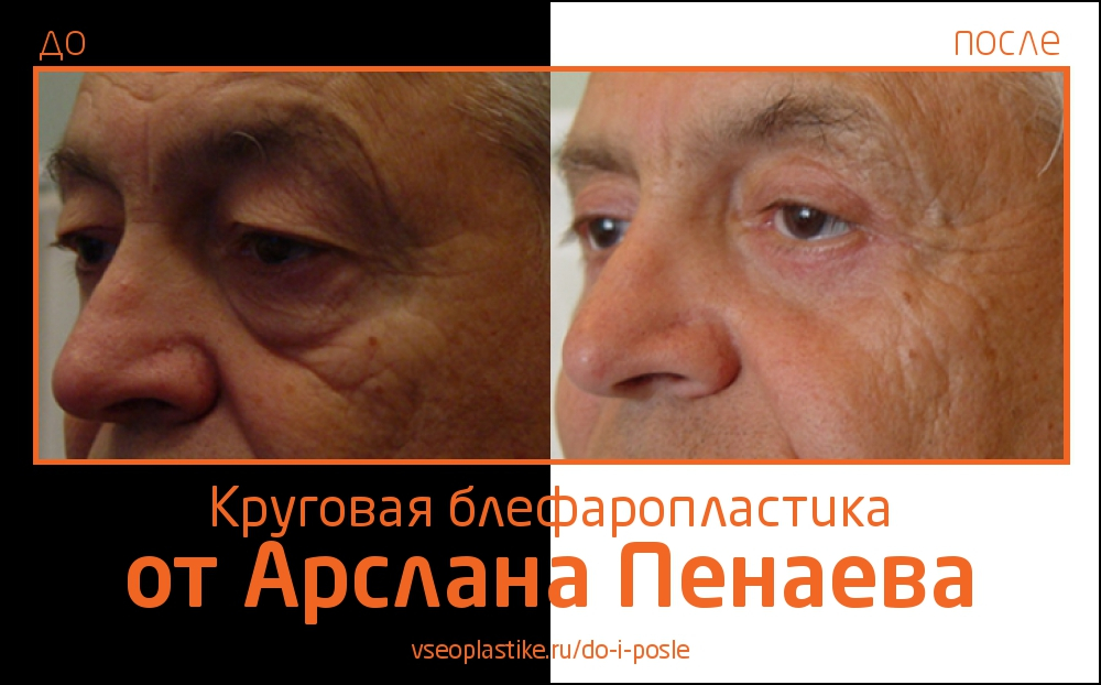 До и после круговой блефаропластики у Арслана Пенаева