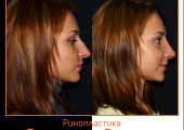 До и после ринопластики у Воладислава Григорянца