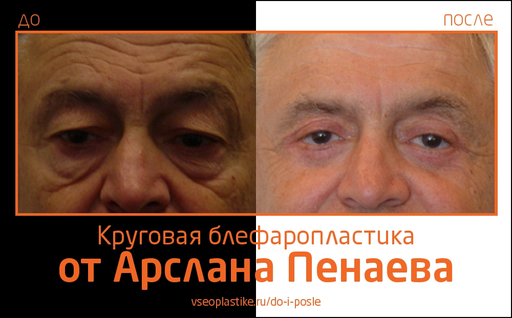 До и после круговой блефаропластики у Арслана Пенаева